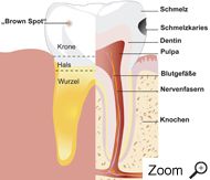 Karies in Schmelz und Dentin Karies in Schmelz und Dentin